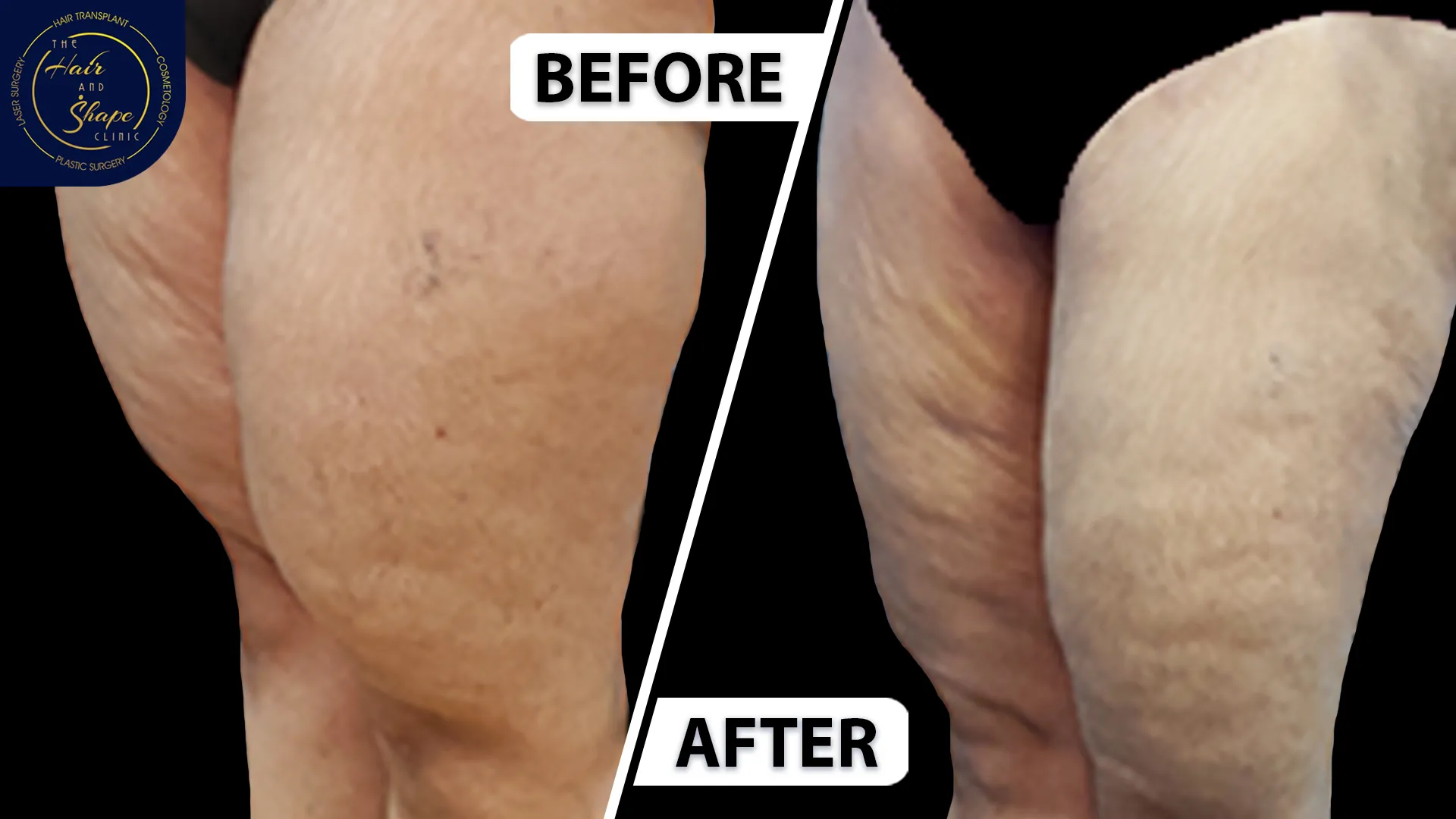 Thigh Liposuction result10